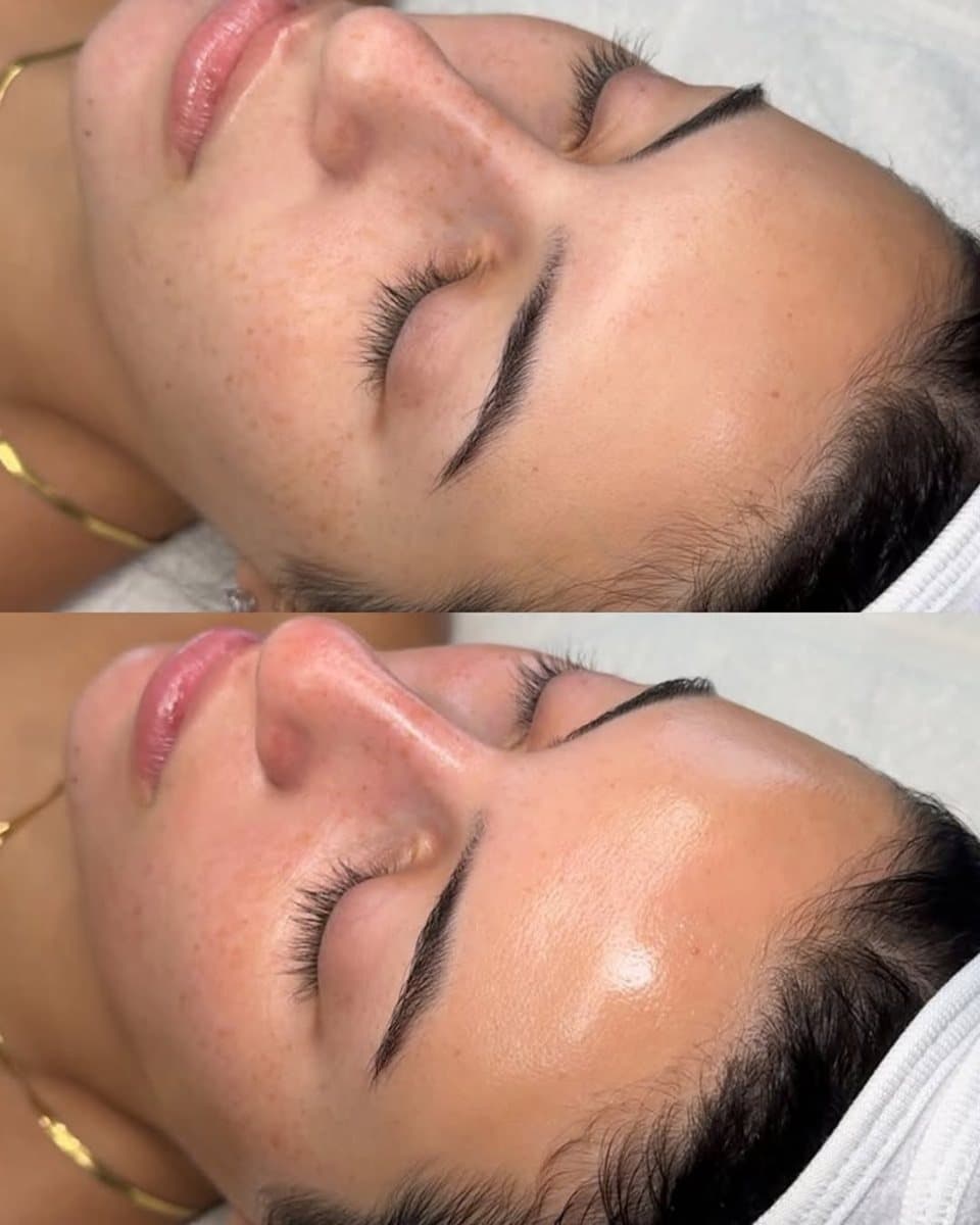 Hydrafacial before / after result no. 1