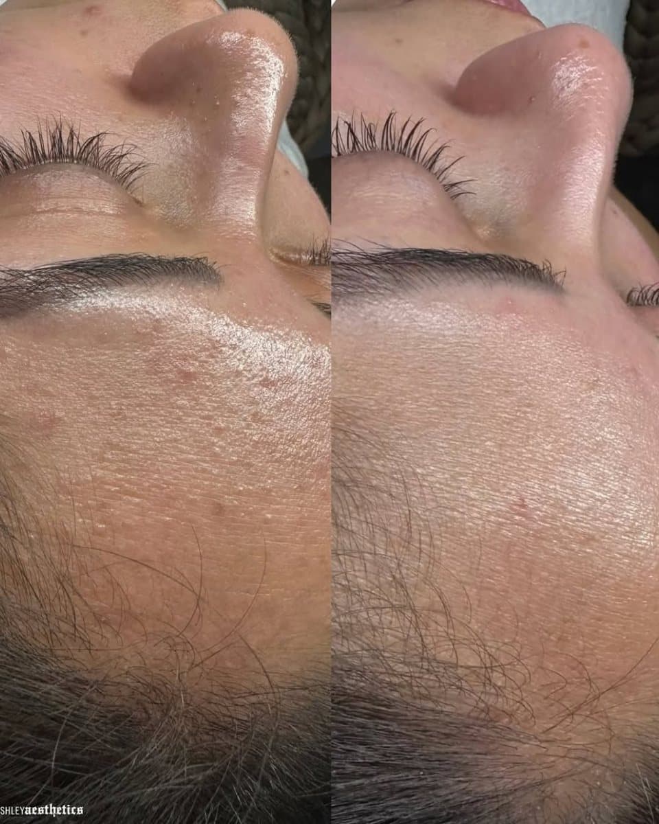 Hydrafacial before / after result no. 2