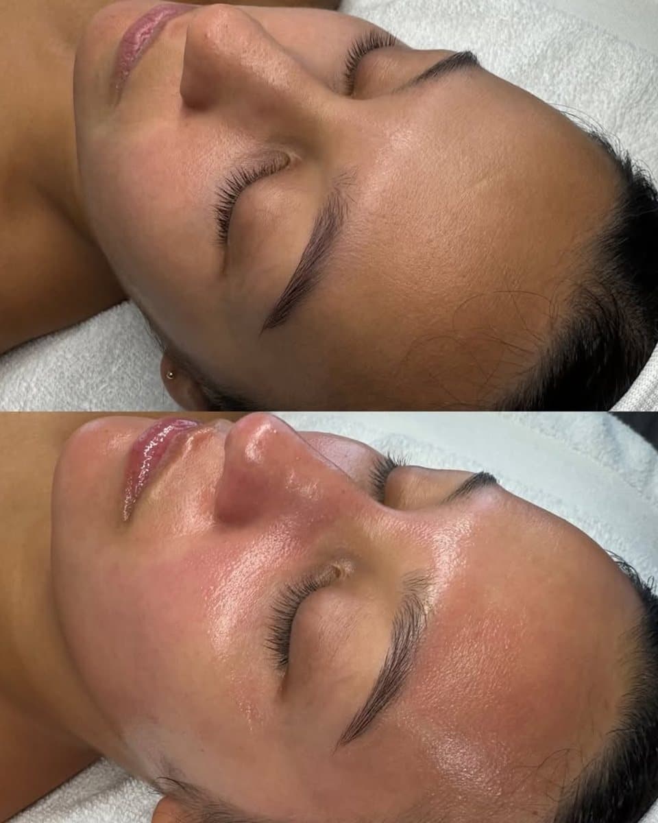 Hydrafacial before / after result no. 3