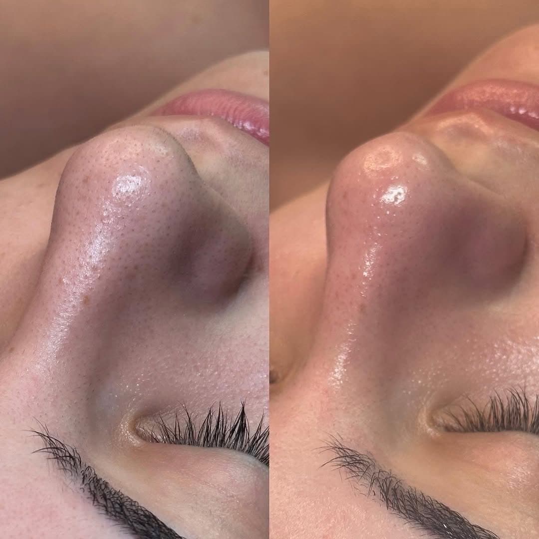 Hydrafacial before / after result no. 4