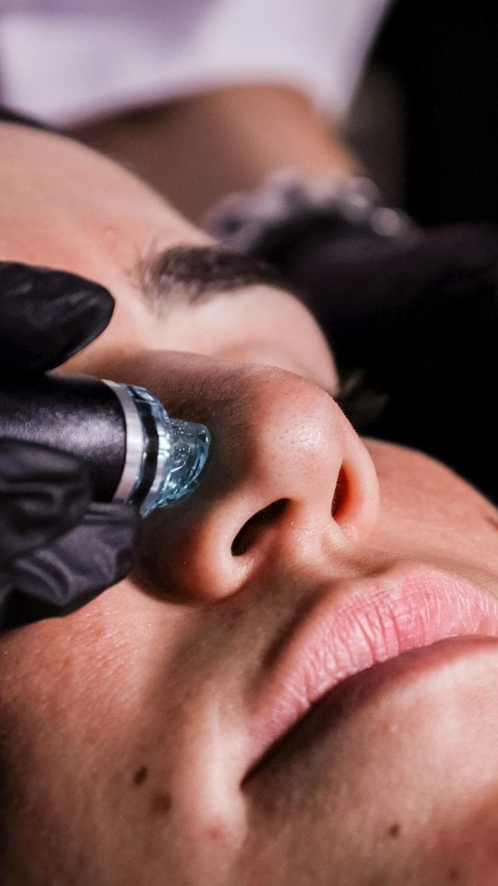 Hydrafacial Vortex-Fusion handpiece in action on the face